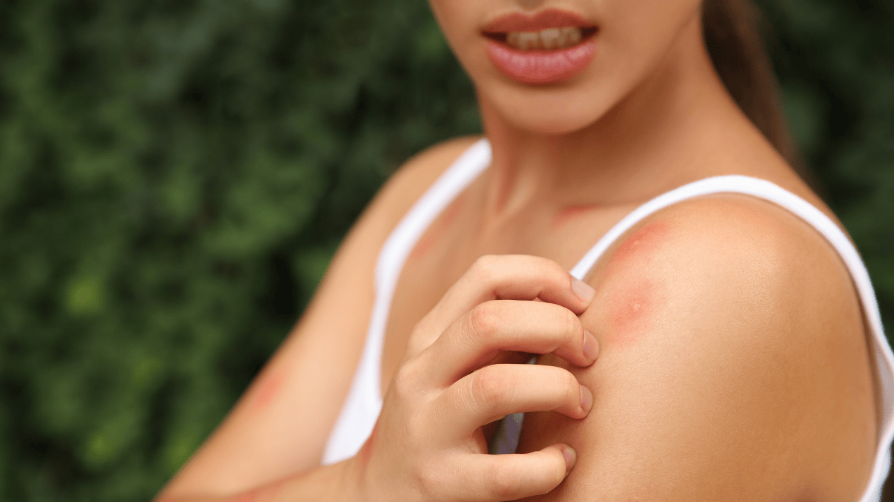 Bug Bites and Itchy Skin